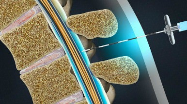 epidural-steroid-injection-featured