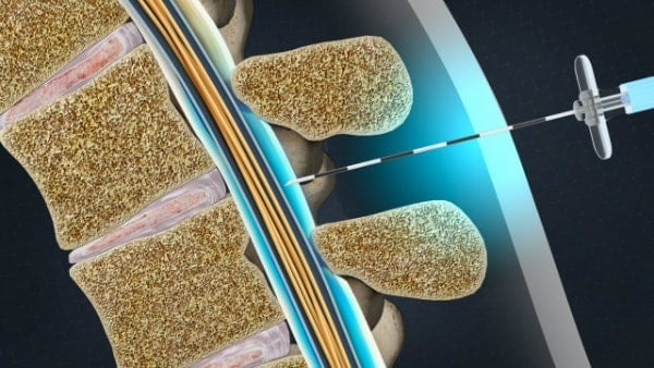 A rendering of an epidural needle injecting anesthetic into the lumbar spine.