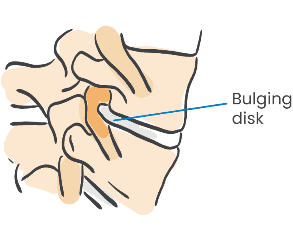 Bulging Disc