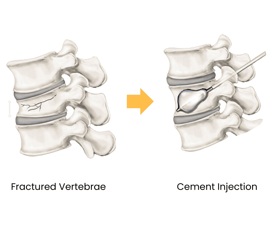OOC vertoplasty
